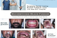 black-fungus-treatment-1-1